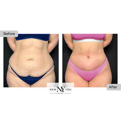 B&A Tummy Tuck 03