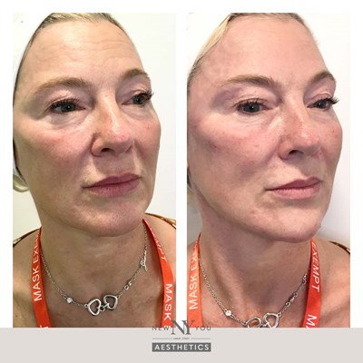 Pic27.Before And Afters Branded Rejuvenation 19