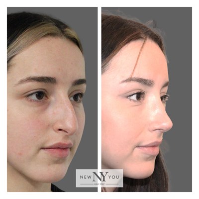 Rhinoplasty Social 17 Side Copy 2