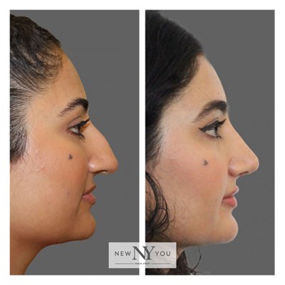 Rhinoplasty Social 2 Side