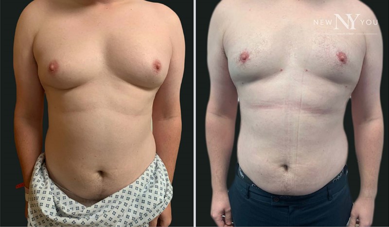 Gynecomastia Patient Dr Alamouti