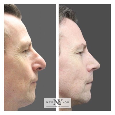 Rhinoplasty Social 5 Side