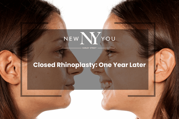 Closed Rhinoplasty: One Year Later