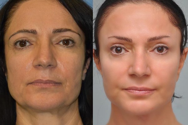 How Long Does a Facelift Last?