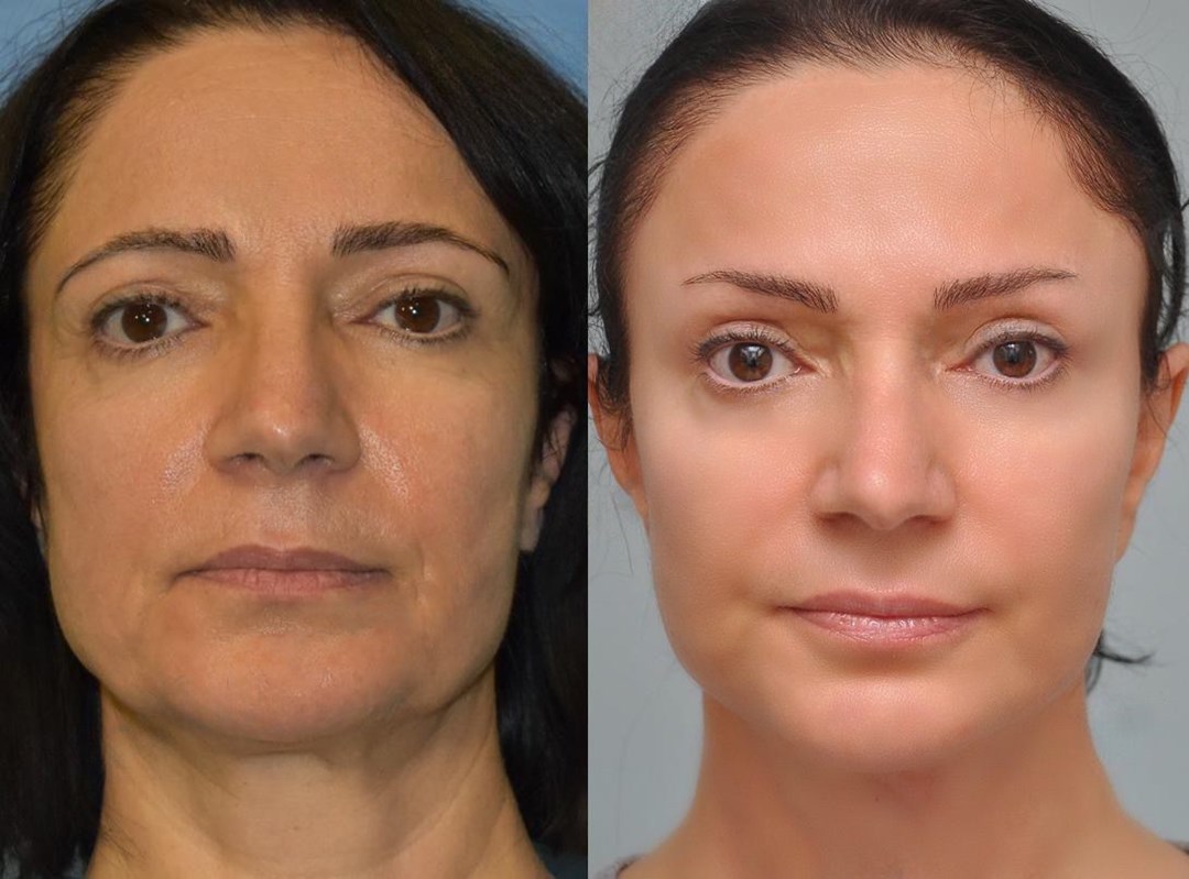 How Long Does a Facelift Last? — New You Harley Street