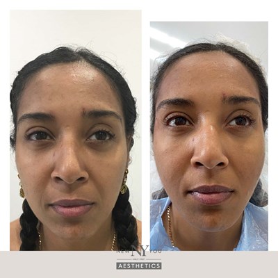Pic26 Pdo .Before And Afters Branded Rejuvenation 15