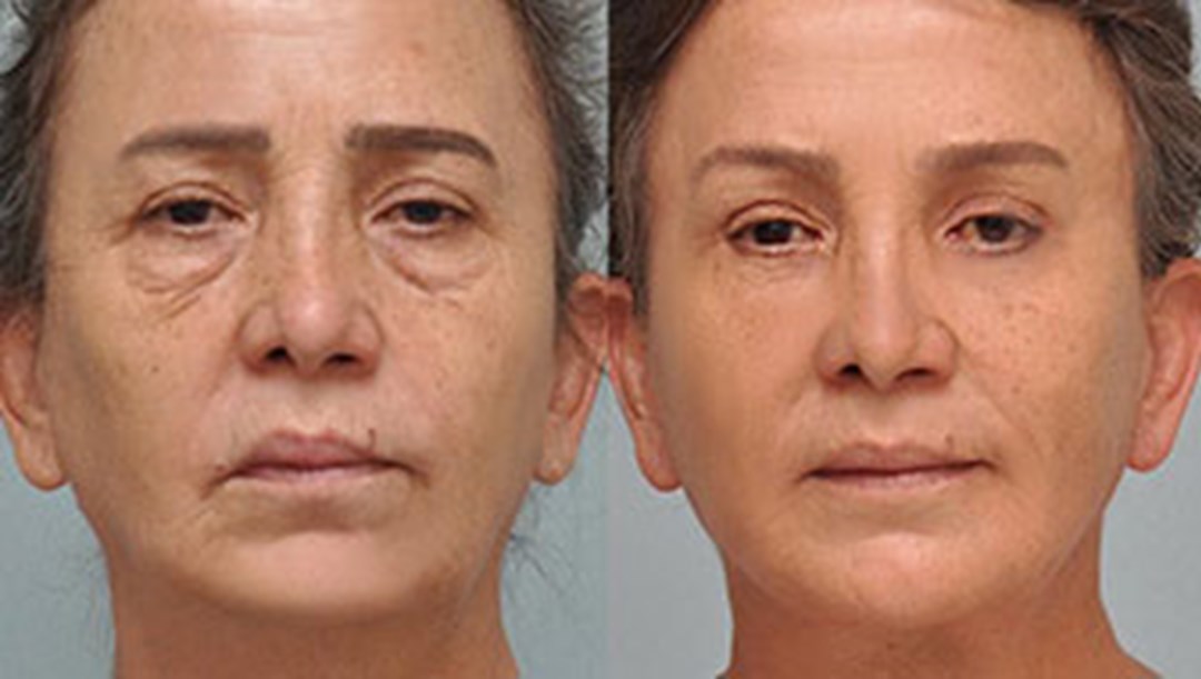 Facelifts: A Comprehensive Guide to Rejuvenating Your Appearance