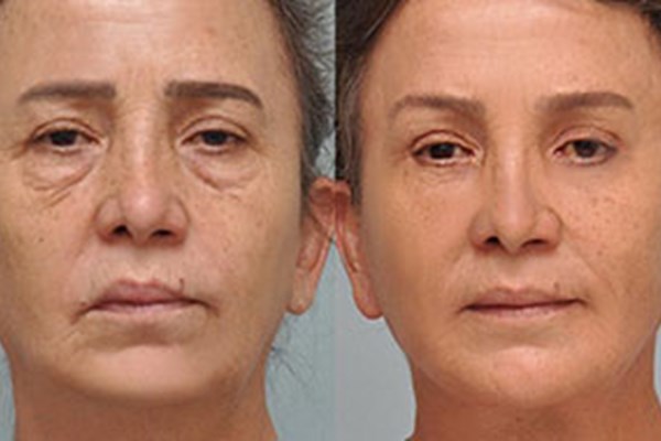 Facelifts: A Comprehensive Guide to Rejuvenating Your Appearance