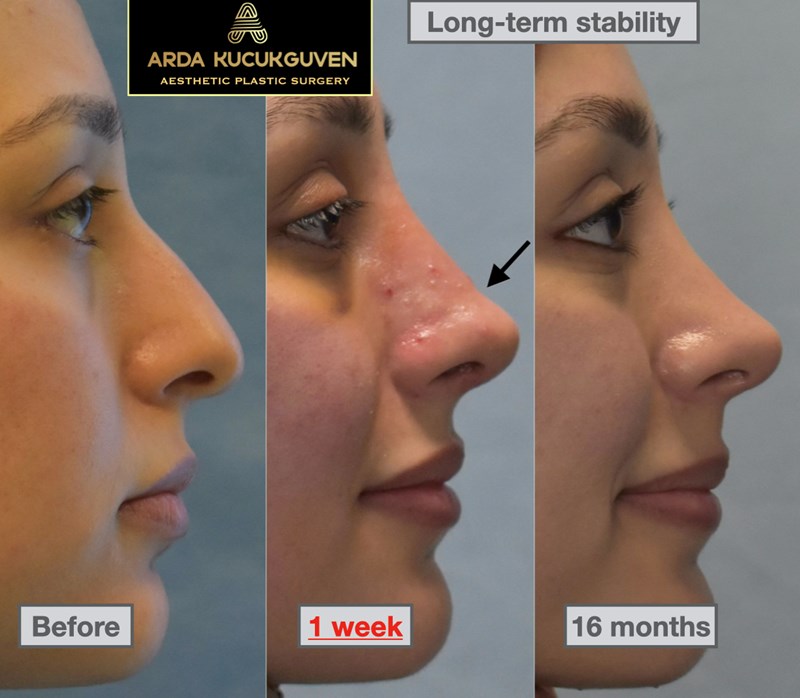 Quick Recovery Rhinoplasty