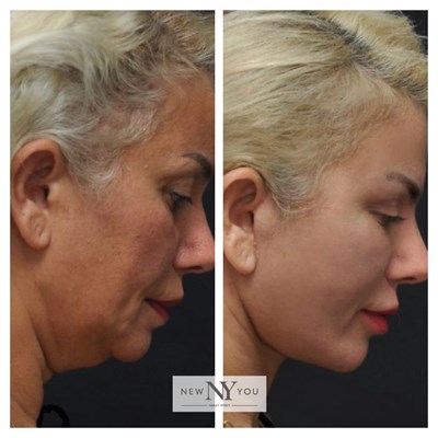 Before And Afters Neck Lift 3