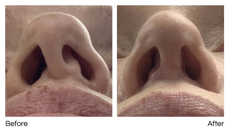 Septoplasty Before and After New You Harley Street