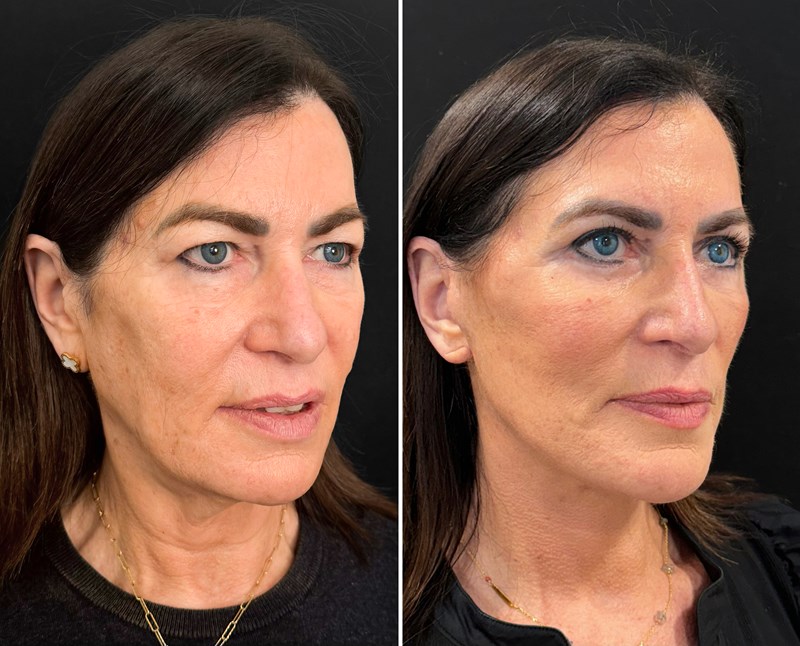 Facelift Before and After