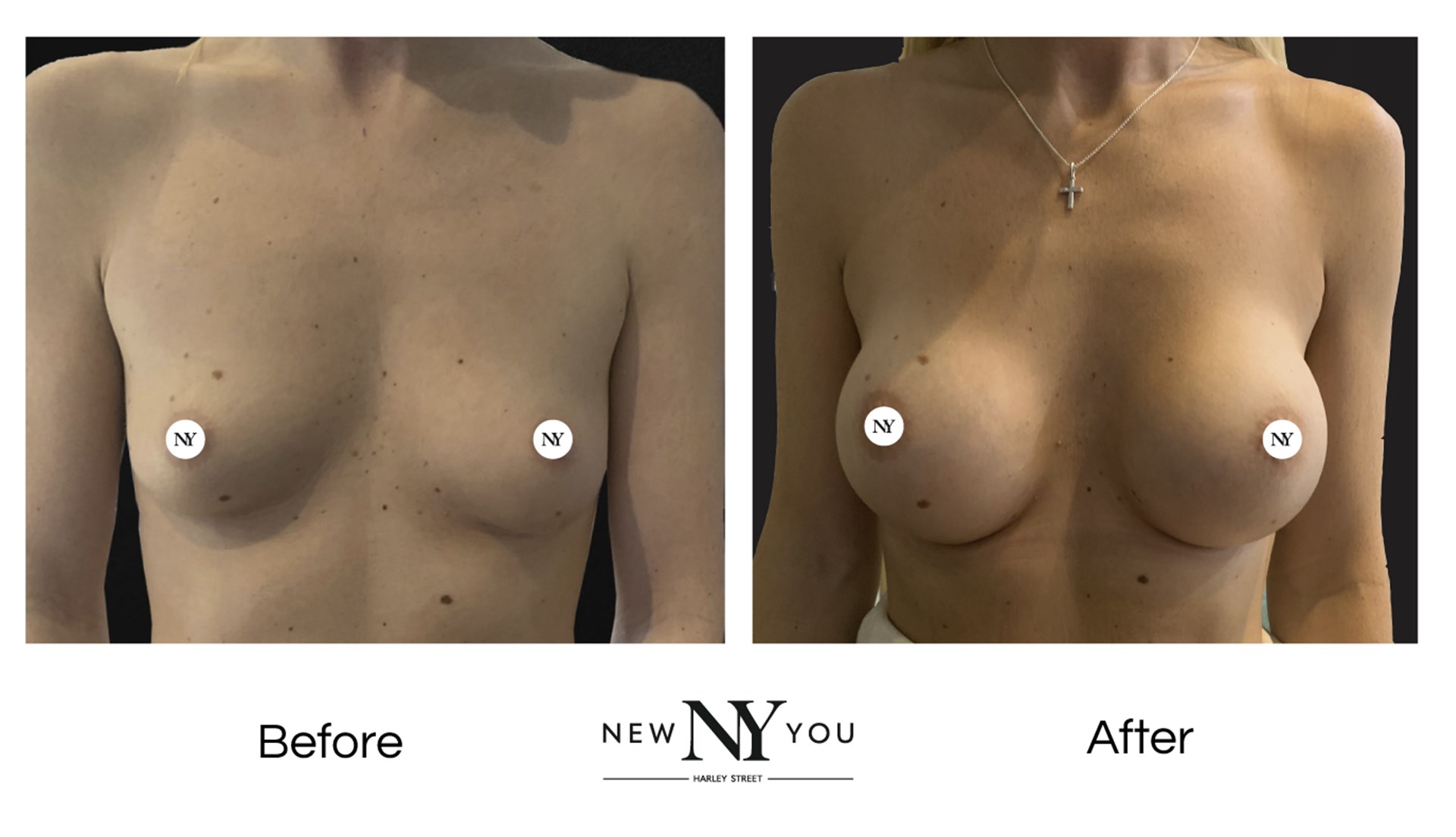 Breast Surgery Patient New You