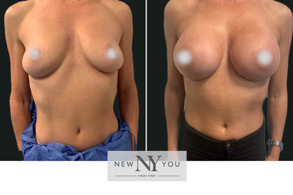 Hybrid Breast Augmentation