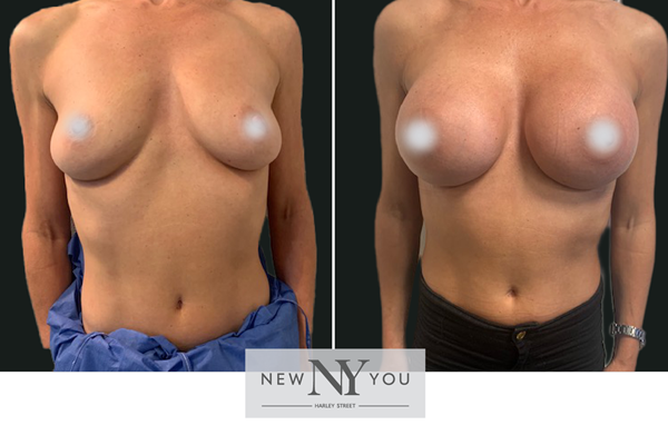 Breast Augmentation