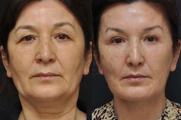 Facelift (Rhytidectomy) Procedures for a Youthful Look