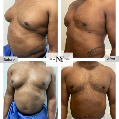 B&A Gynecomastia