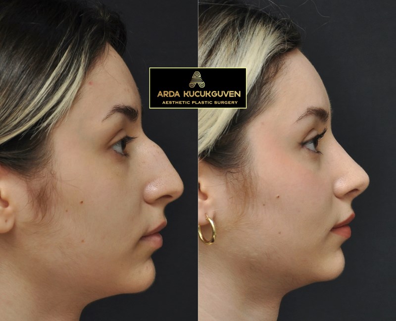 Ethnic Rhinoplasty