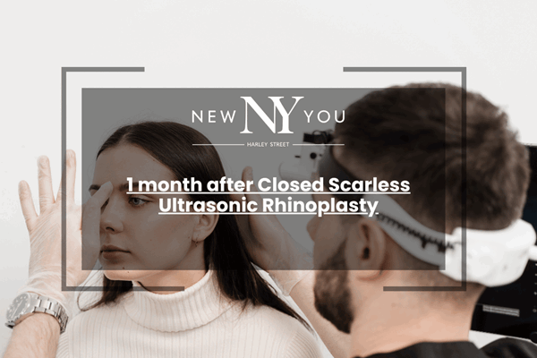 1 month after Closed Scarless Ultrasonic Rhinoplasty