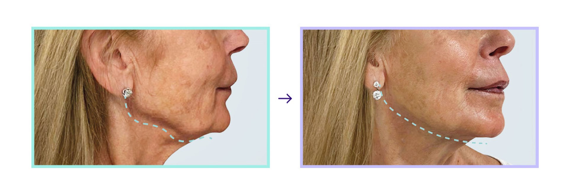 Mint PDO Thread Lift - jawline