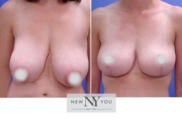 Breast Reduction