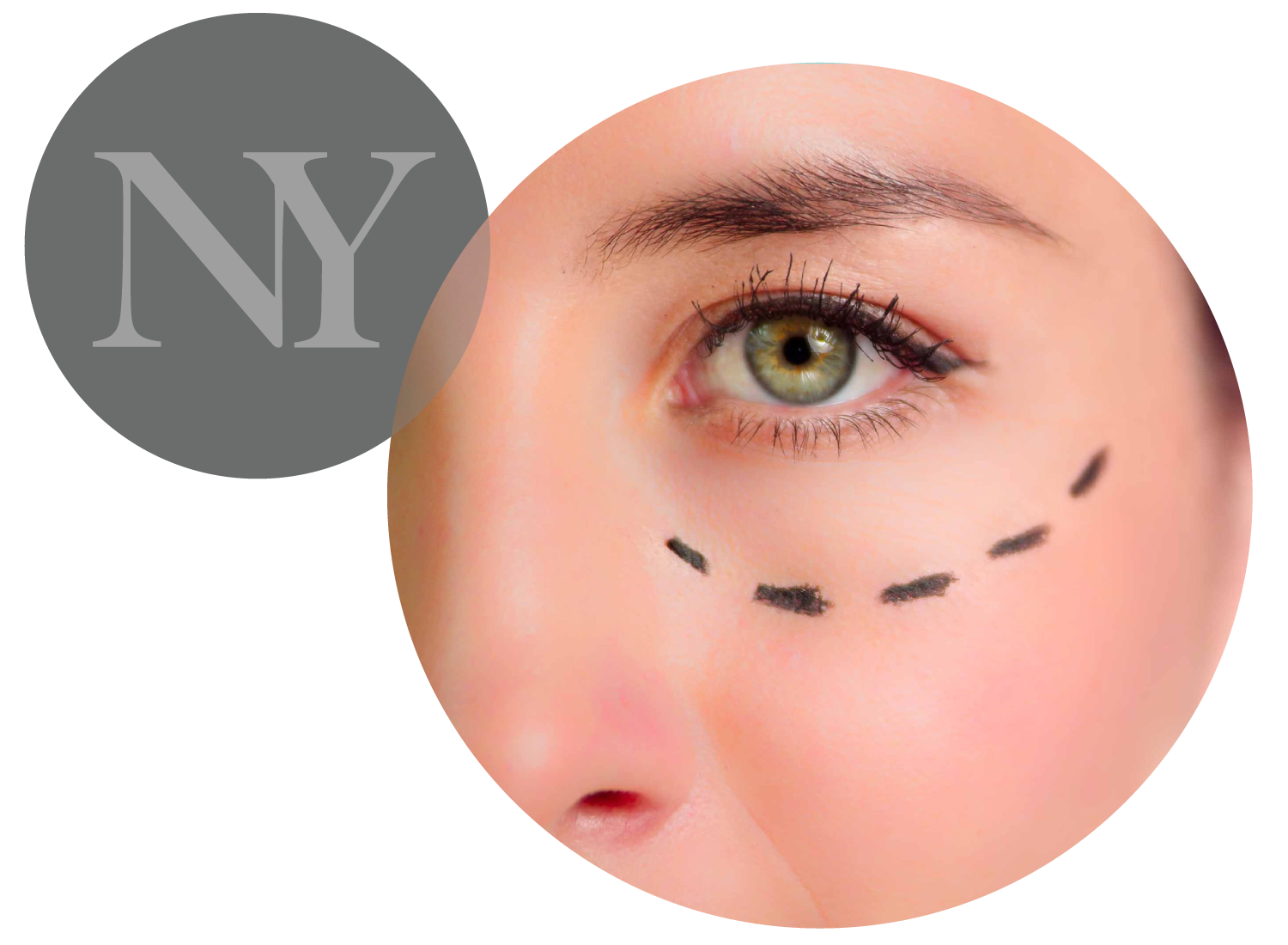 Lower Blepharoplasty