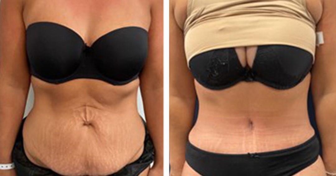 Looking for the Best Tummy Tuck Surgeon? — New You Harley Street