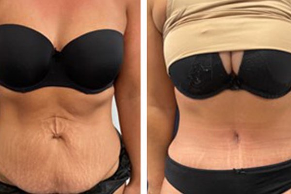 Looking for the Best Tummy Tuck Surgeon?