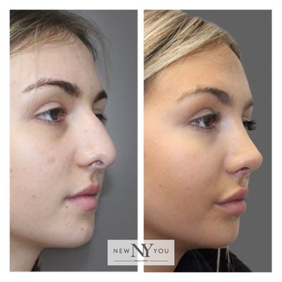 Rhinoplasty Social 9 3 4