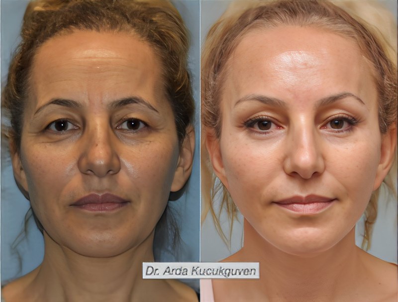 Facelift Before and After