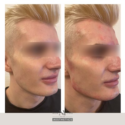 Before And Afters Branded Jawline 45 Blurred