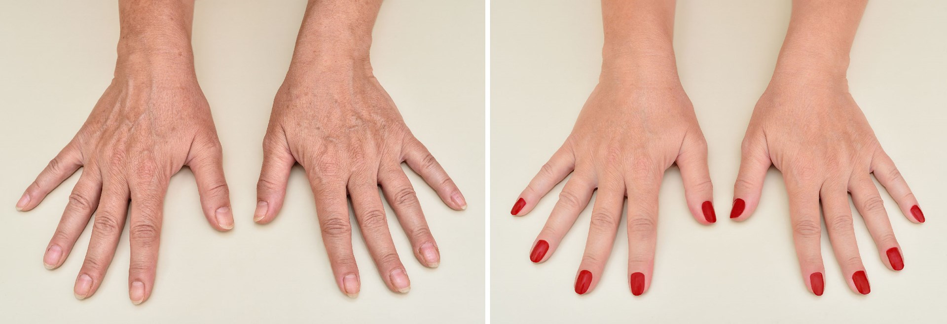 Hand Rejuvenation Before and After