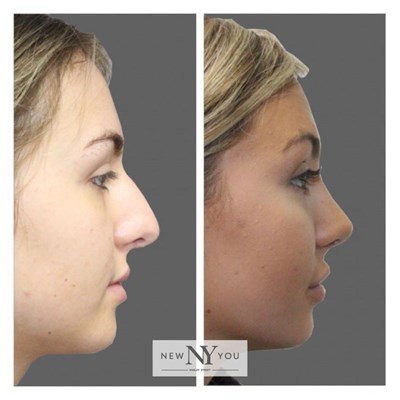 Rhinoplasty Social 8 Side