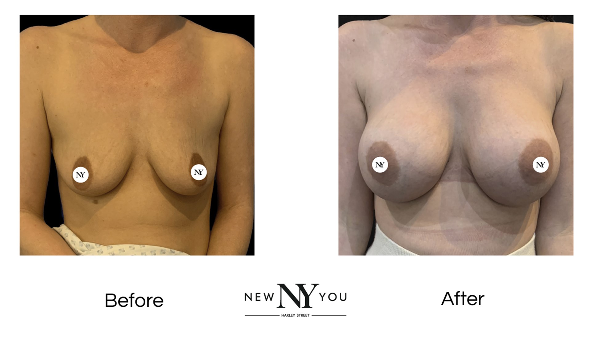 Breast Surgery Patient New You