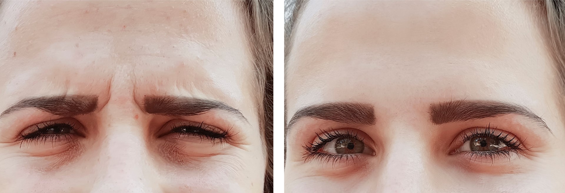 Example of how anti wrinkle treatments can improve the appearance of forehead / brow lines