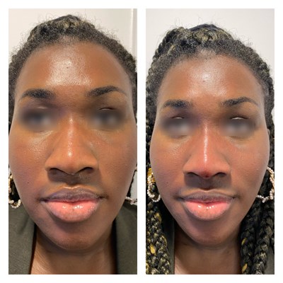 Before And Afters 2 Nose 13 Frontal