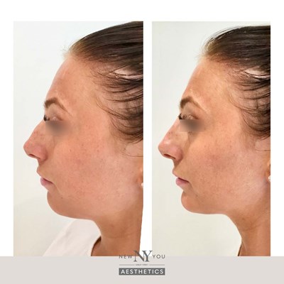 Before And Afters Branded Chin Filler 01 Blurred