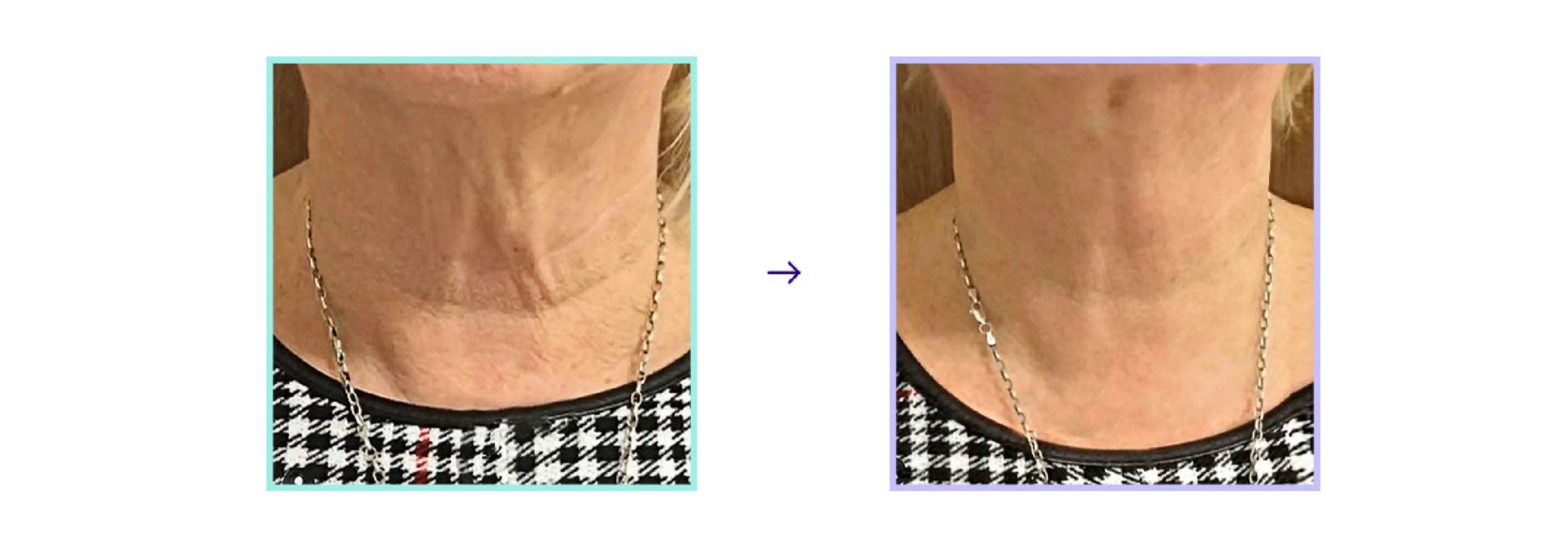 Mint PDO Thread Lift - Neck Lift