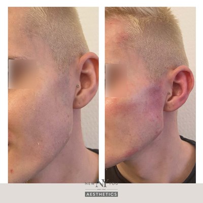 Before And Afters Branded Jawline 46 Blurred