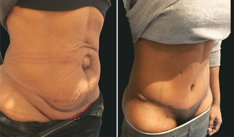Abdominoplasty Before and After Dr Reza Alamouti