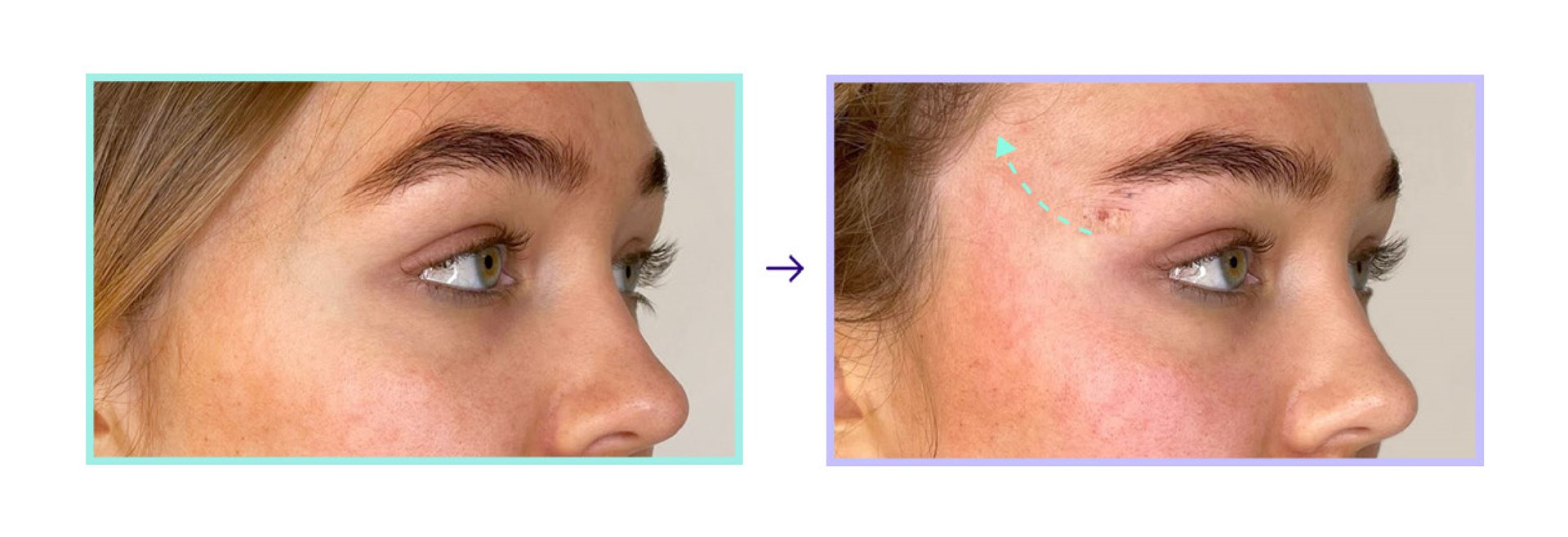 Mint PDO Thread Lift - Cat and Eyebrow Lift