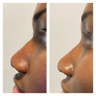 Before And Afters 2 Nose 13 Profile