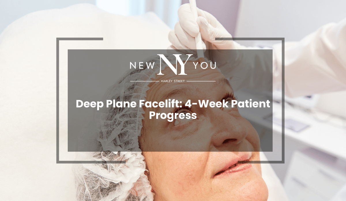 Deep Plane Facelift: 4-Week Patient Progress