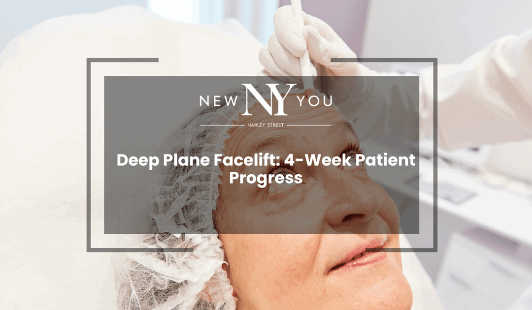 Deep Plane Facelift: 4-Week Patient Progress