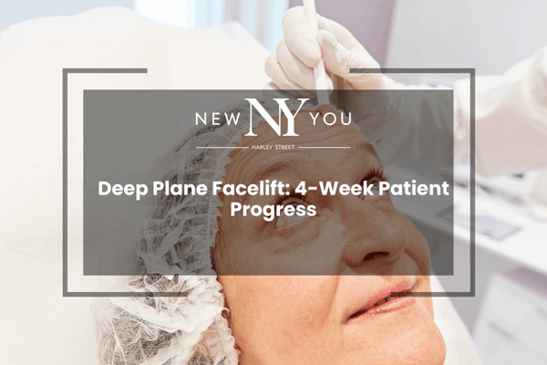 Deep Plane Facelift: 4-Week Patient Progress