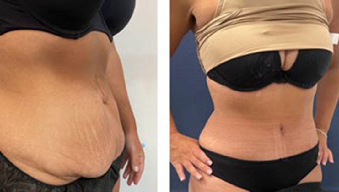 How much does a Tummy Tuck Cost?