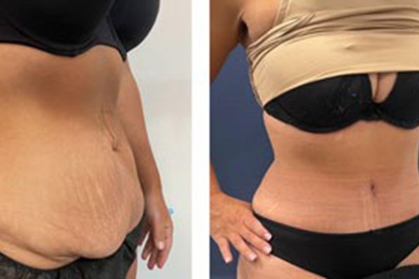 How much does a Tummy Tuck Cost?