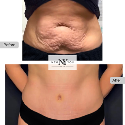 B&A Tummy Tuck 02